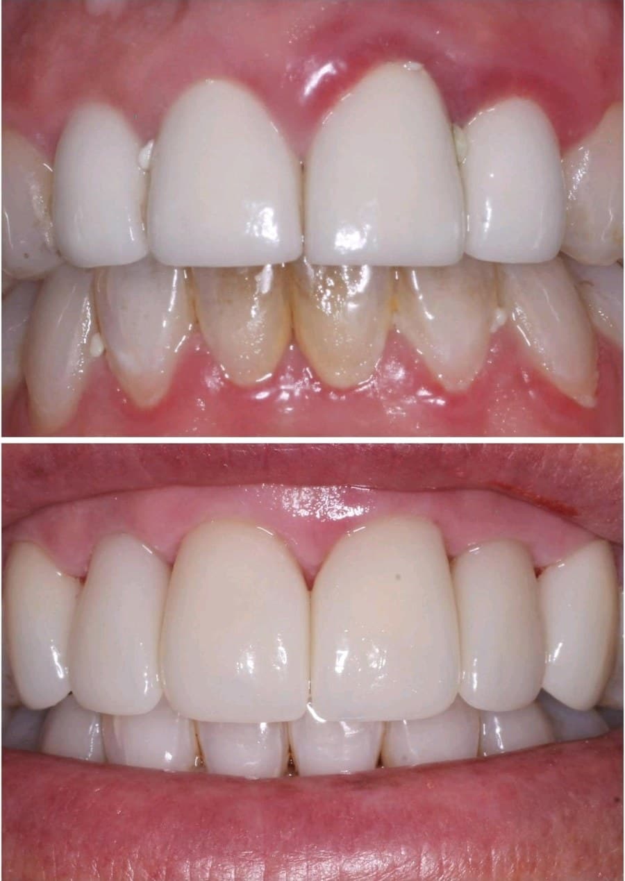 Before and after anterior crowns intraoral view — improved form and shade on upper front teeth — Natural Esthetics dental lab Tampa