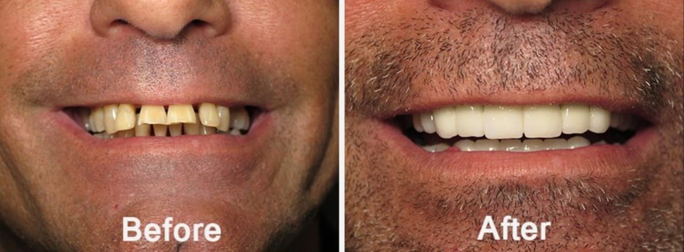 Before and after full-arch restoration — worn, uneven teeth restored to a uniform white smile — Natural Esthetics dental lab Tampa Bay