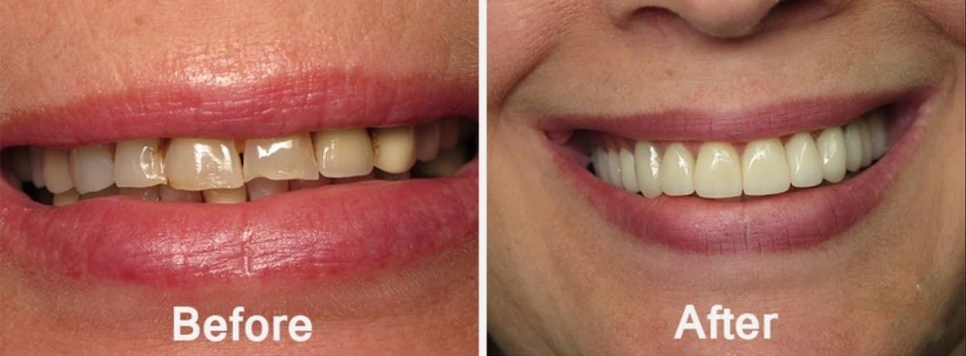 Before and after smile makeover — chipped, stained anterior teeth restored with shade-matched crowns — Tampa Bay dental lab